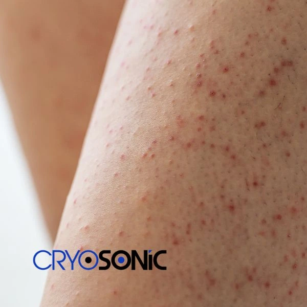 Looking for Seborrhoeic Keratosis removal Swansea treatment? Call our consultants today in Swansea