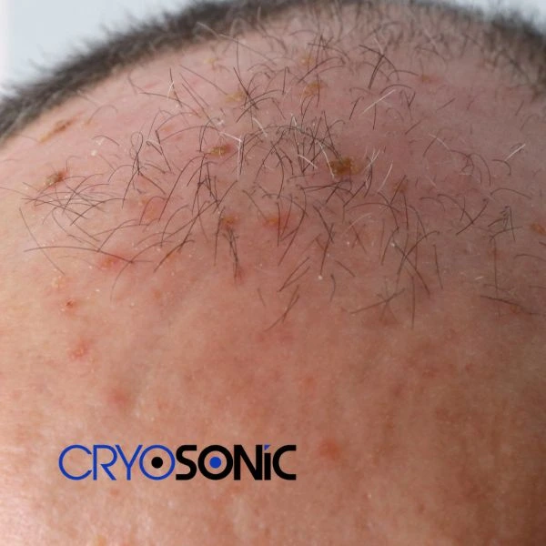 Access Seborrhoeic Keratosis removal from the comfort of your own home! Call us today in Swansea