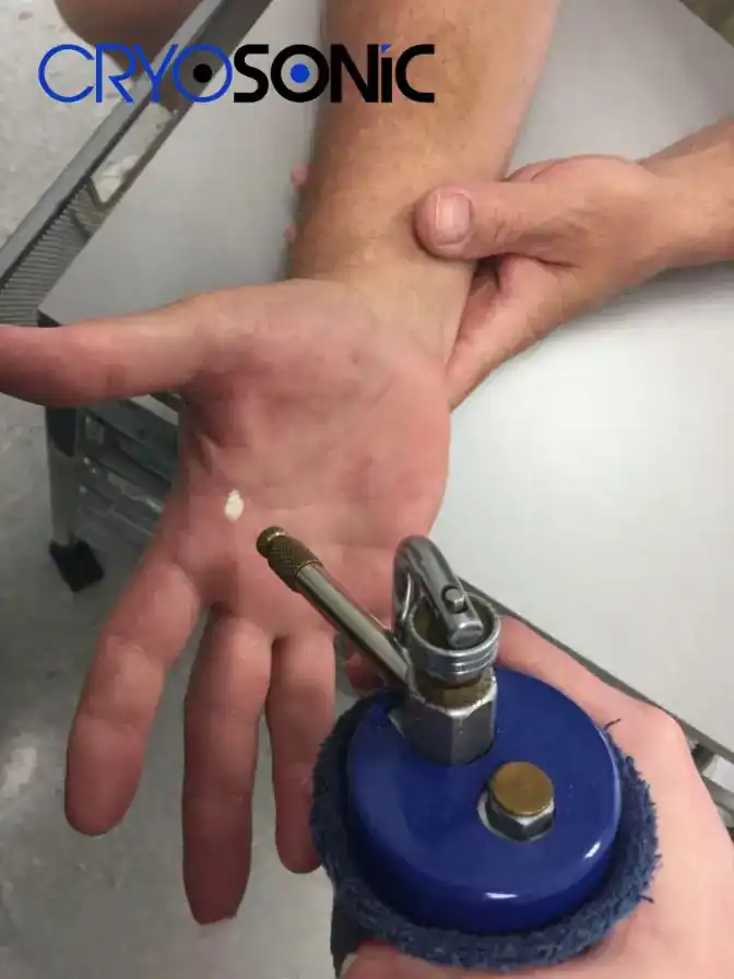 Temperature Differences: OTC vs Medical-Grade Cryotherapy Swansea